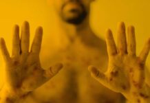 La OMS declara la emergencia sanitaria internacional por el brote de viruela del mono