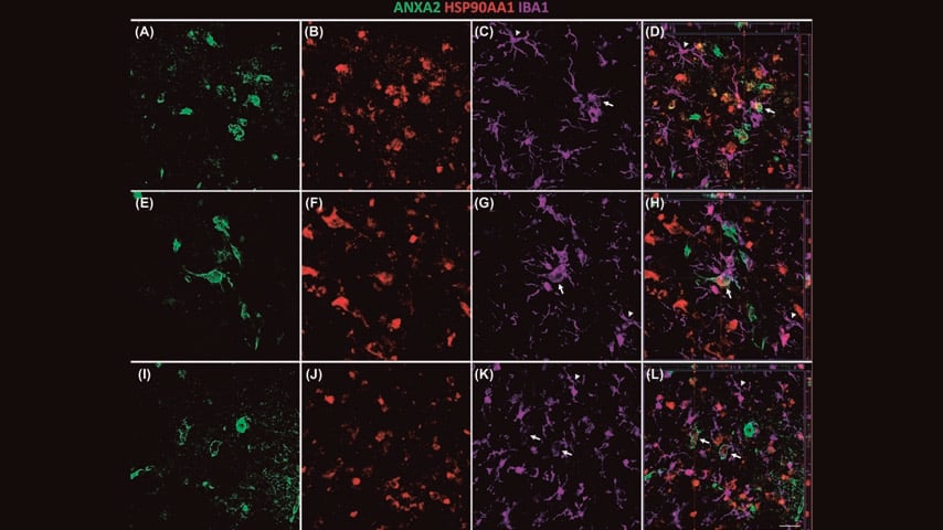 Una investigación de UCLM podría mejorar diagnóstico y tratamiento del alzhéimer