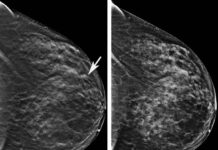 Sanidad prevé adjudicar el concurso para hacer mamografías en Talavera para empezar «a primeros de año»